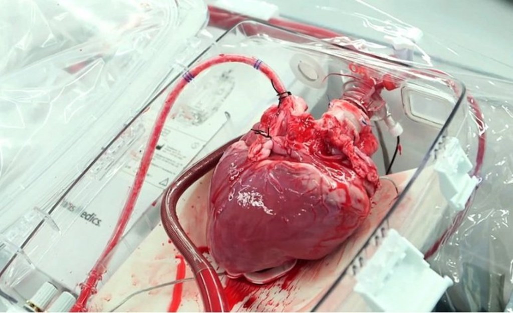 Heart-Transplant-Market.jpg Heart-Transplant-Market.jpg